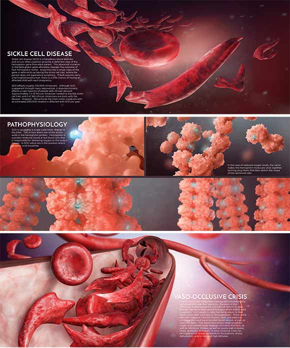 <span class="content-image-text">CIA student Grace Gongaware's Sickle cell piece, one of the winners of the Award of Excellence Association of Medical Illustrators annual salon this past July</span>