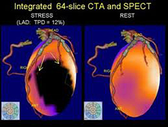 Myocardial Perfusion Scan