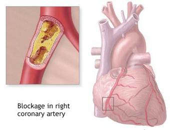 Coronary Artery