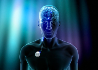 Libra Deep Brain Stimulation