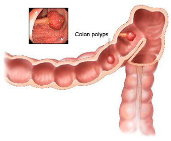 Lynch syndrome